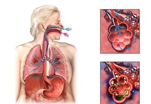 Pneumonia: Sintomas e Cuidados para Crianças, Adultos e Bebês