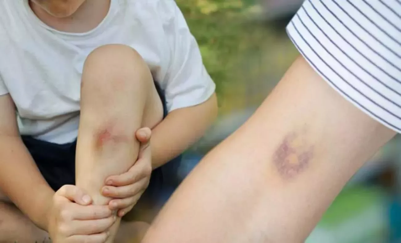 Hematomas que surgem do nada: entenda as possíveis causas